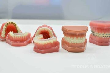 Precio de los brackets en Madrid