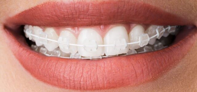 Precio brackets transparentes