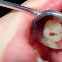 Precio de endodoncia
