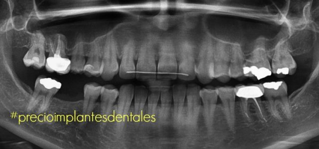 precio implantes toda la boca precio implantes dentales madrid