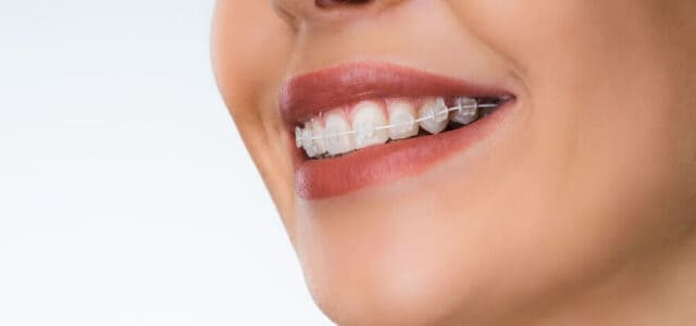 ¿Cuánto cuestan los brackets transparentes?