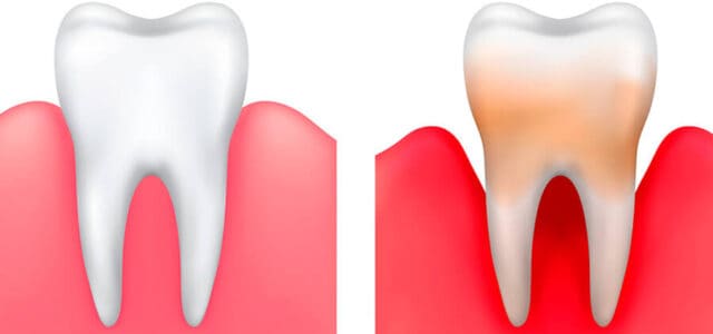 Periodontitis