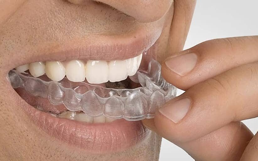 Puedo hablar con ortodoncia con Invisalign