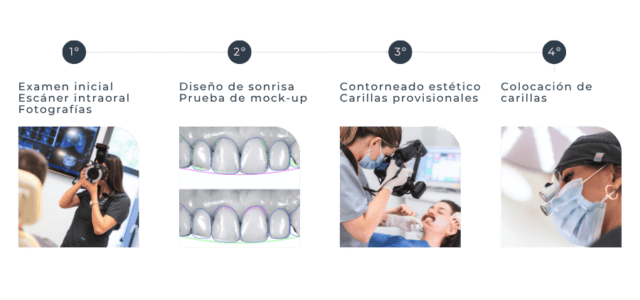 Proceso de colocación de las carillas dentales paso a paso
