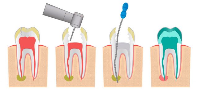 Endodoncia de un diente