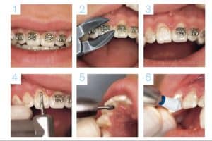 Pasos para quitar los brackets