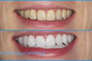 mejores productos de blanqueamiento dental