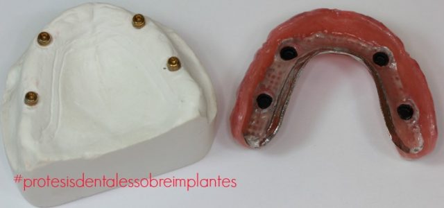 protesis dental fija completa protesis dental fija hibrida