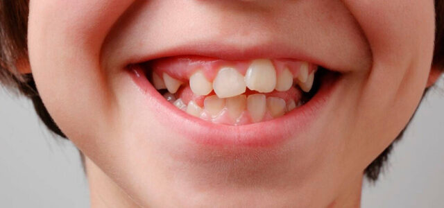 Dientes salidos Protrusión dental