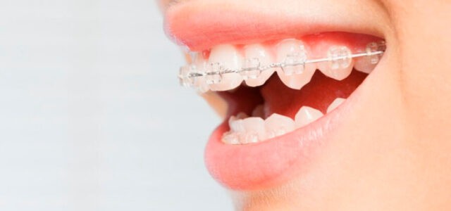 Protrusión dentaria