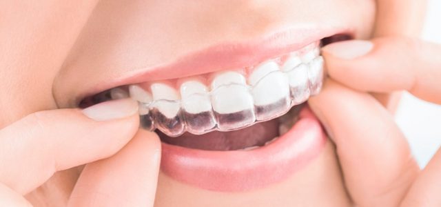 Qué ortodoncia es más cómoda para hablar