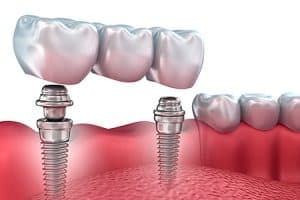 Puente dental sobre implantes