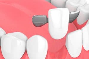 Puentes dentales Maryland
