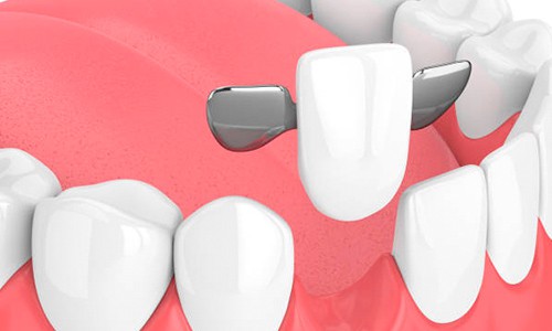 Inspiración Ciencias Insignificante Puentes dentales: ¿son mejores que los implantes? | Ferrus&Bratos