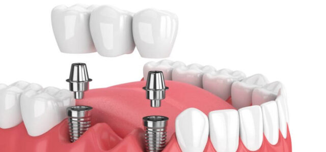 Puente dental sobre dos implantes