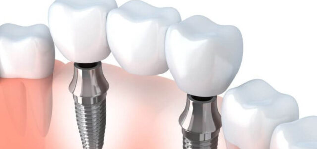Puente dental sobre implantes