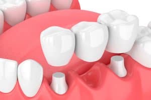 Puente dental más común