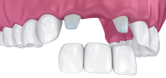 Puente dental de tres piezas