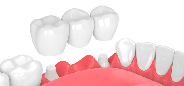 Prótesis dental fija: todos los tipos que existen