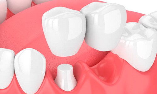 Inspiración Ciencias Insignificante Puentes dentales: ¿son mejores que los implantes? | Ferrus&Bratos
