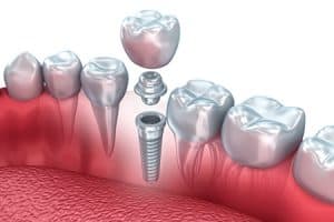 Diferencias entre puentes e implantes dentales