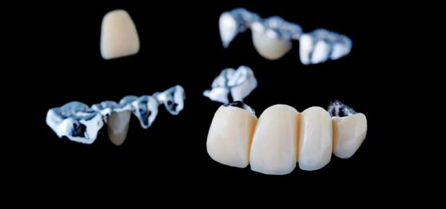¿Qué son los puentes dentales?