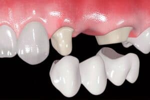 Puente dental