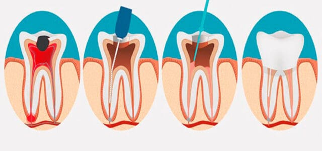 Pulpectomía pasos