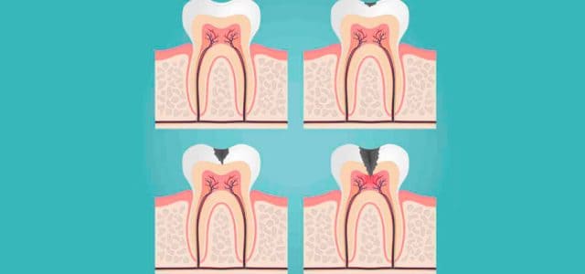 La pulpitis tiene diferentes fases