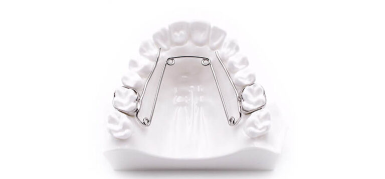 ¿Qué es el Quad Helix y para qué sirve en ortodoncia?