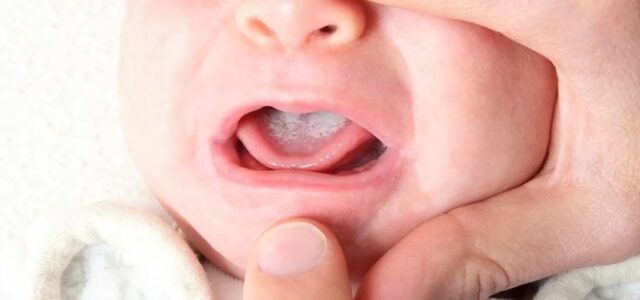 Por qué se produce la candidiasis oral