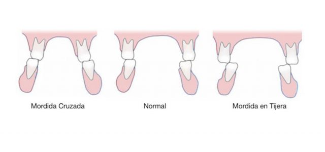 Mordida cruzada y mordida en tijera