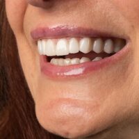 Carillas dentales y su definición
