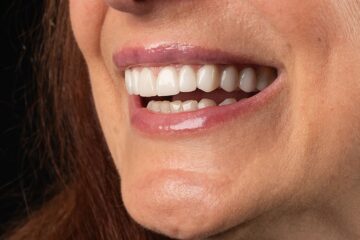 Carillas dentales y su definición