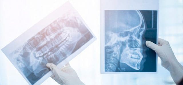 Complicaciones de los dientes supernumerarios Cómo se trata la hiperdoncia