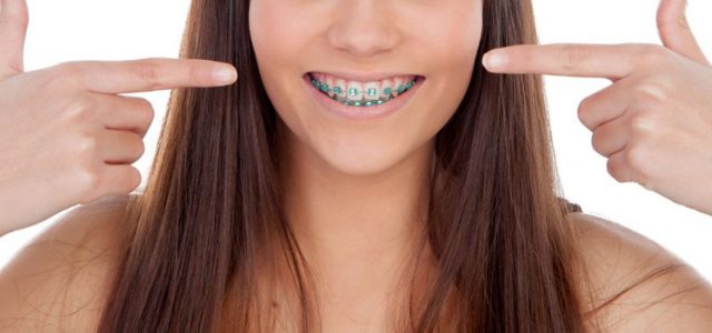 Tipos de ortodoncia sin brackets