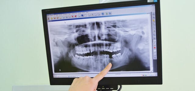 Pérdida de una pieza dental