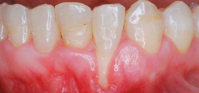 Síntesis de hơn 24 artículos: como se cura la periodontitis [actualizado recientemente]