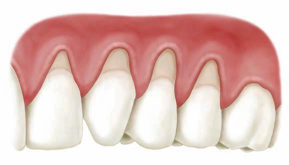 Deterioro estético de la sonrisa