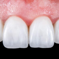 Tipos de reconstrucciones dentales