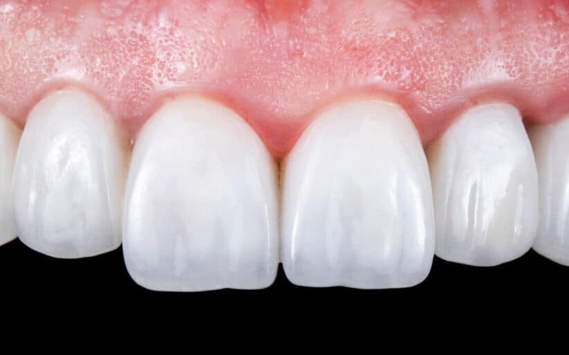 Tipos de reconstrucciones dentales