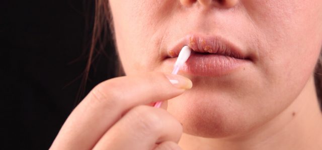 Remedios caseros para curar las molestas llagas de la boca