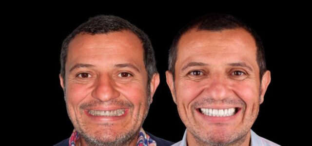 Caso paciente con tetraciclinas puede hacerse un blanqueamiento dental