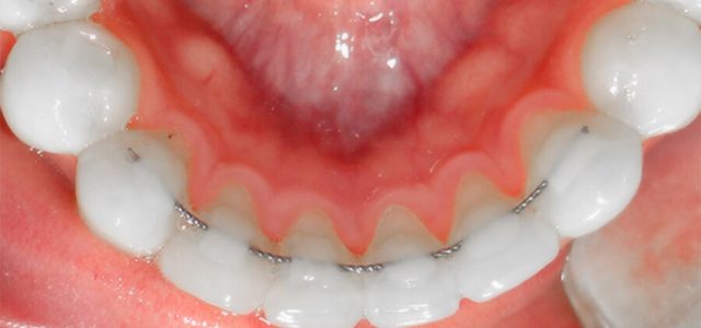 diamante esponja Gigante Cuida tus retenedores dentales con estos 7 consejos | Ferrus&Bratos