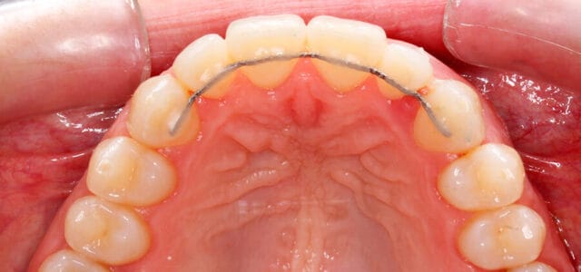 Retenedores después de la ortodoncia