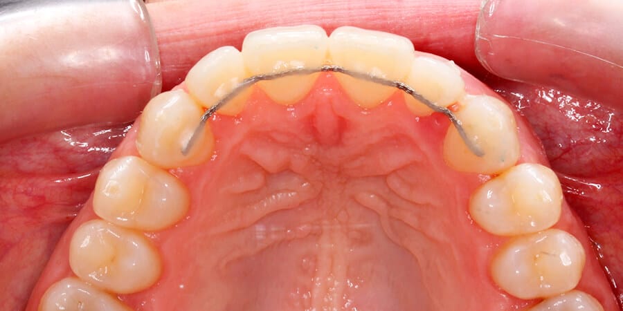 Brackets mes a mes fotos