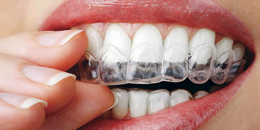matraz Automáticamente Prisionero de guerra Es tan importante llevar retenedores tras la ortodoncia? | Ferrus&Bratos