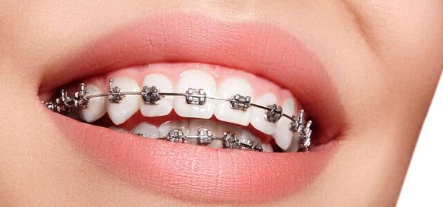 Retratamiento de ortodoncia
