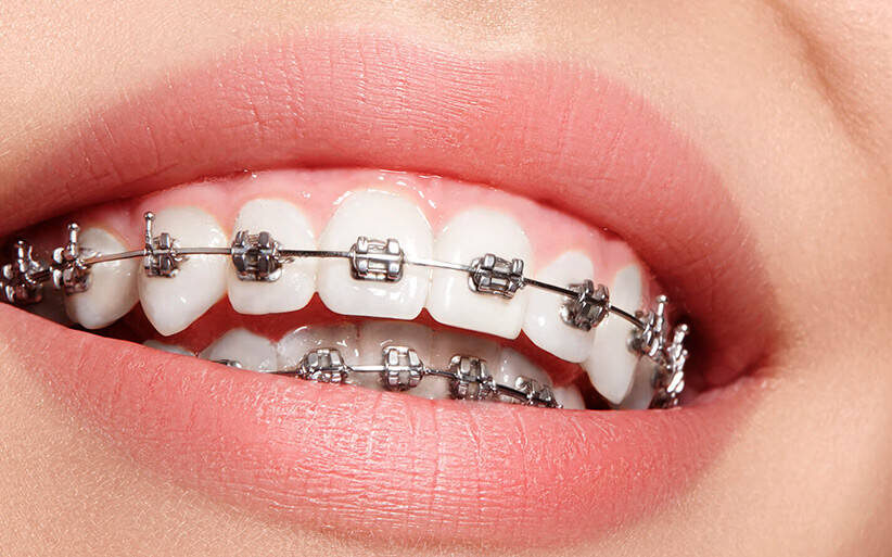 Retratamiento de ortodoncia