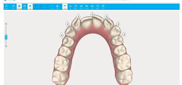 ClinCheck de Invisalign